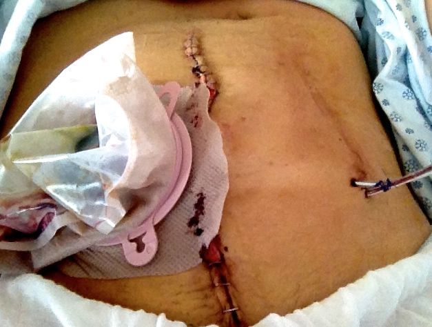 May 2013 surgery (this main incision would be cut through 3 times in total)